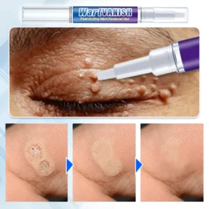 WartVanish™ Fast-Acting Wart Removal Gel