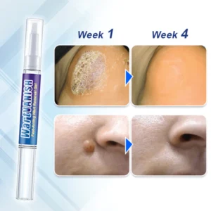 WartVanish™ Fast-Acting Wart Removal Gel