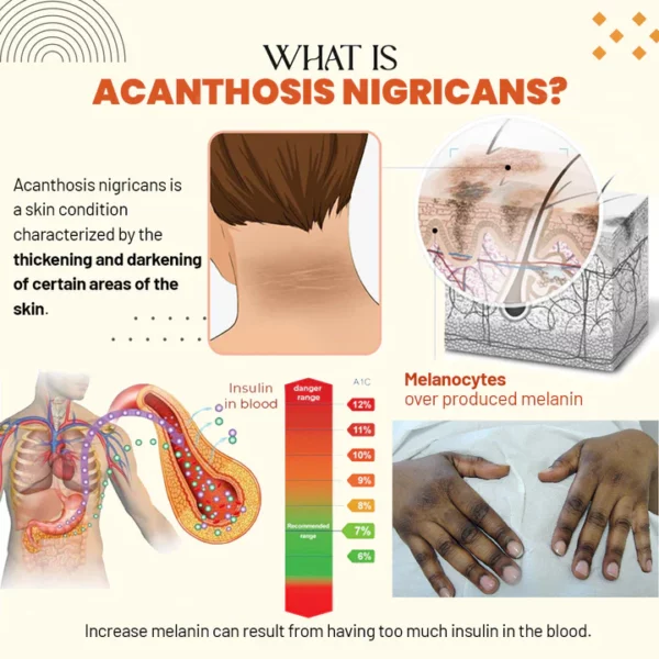 Zakdavi™ Acanthosis Nigricans Therapy Oil