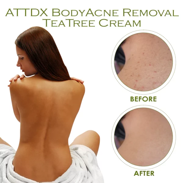 ATTDX BodyAcne Removal TeaTree Cream - Image 4