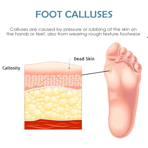 ATTDX FootCorn CallusesRemoval Plaster - Image 6