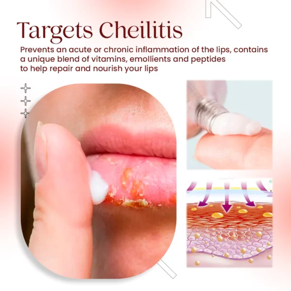 Cold Sores Lip Cheilitis Treatment Cream - Image 3