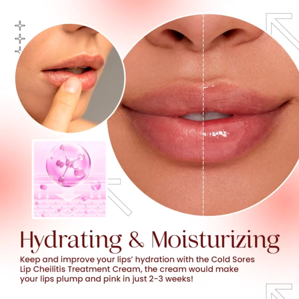 Cold Sores Lip Cheilitis Treatment Cream - Image 5