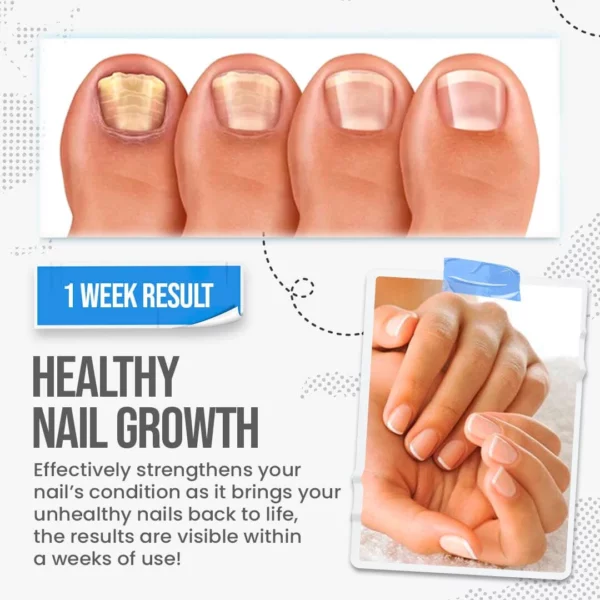 Fungus Shield Nail Treatment Cream