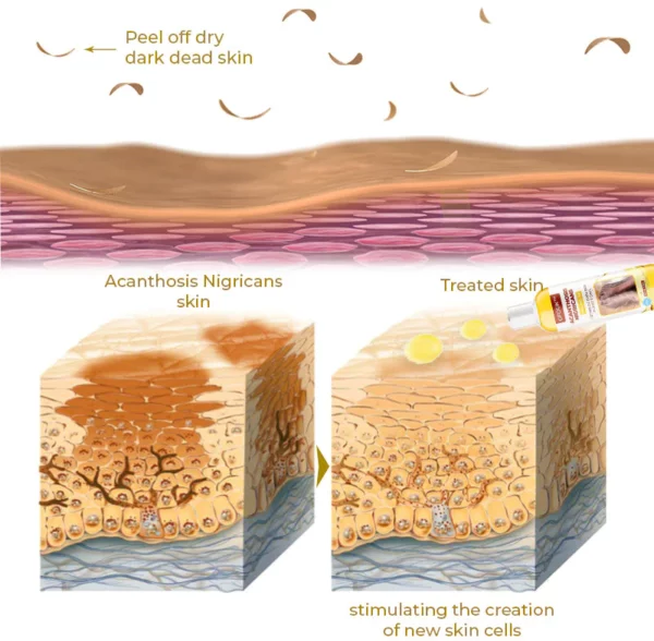 GFOUK™ Acanthosis Nigricans Peeling Oil - Image 3