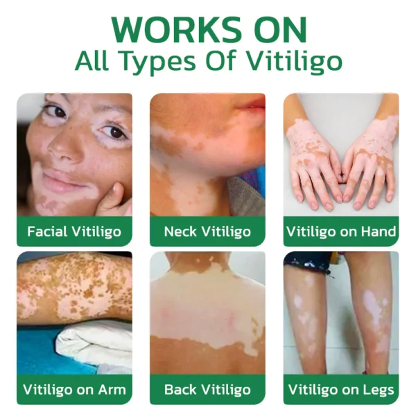 GFOUK™ TreatVitiligo Soothing Cream - Image 6