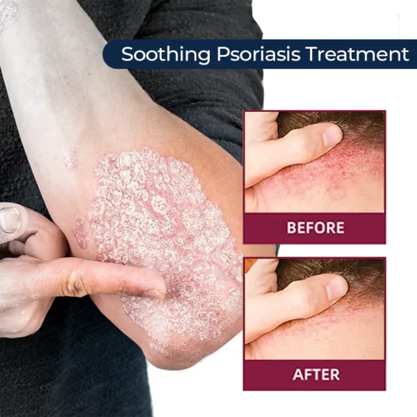 MEDix™ Psoriasis Therapy Spray - Image 3