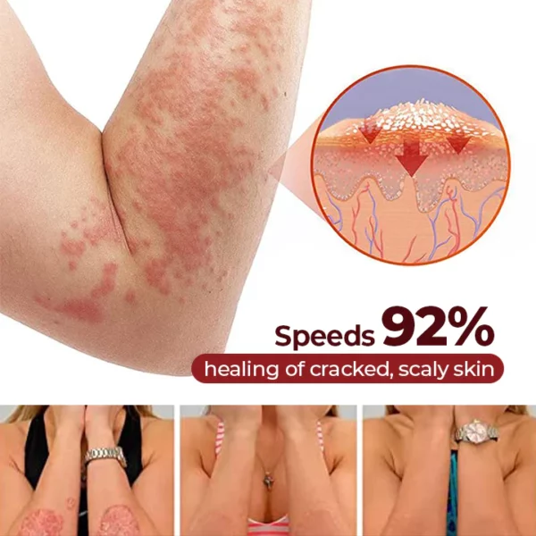 MEDix™ Psoriasis Therapy Spray - Image 9