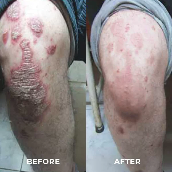 MEDix™ Psoriasis Therapy Spray - Image 7