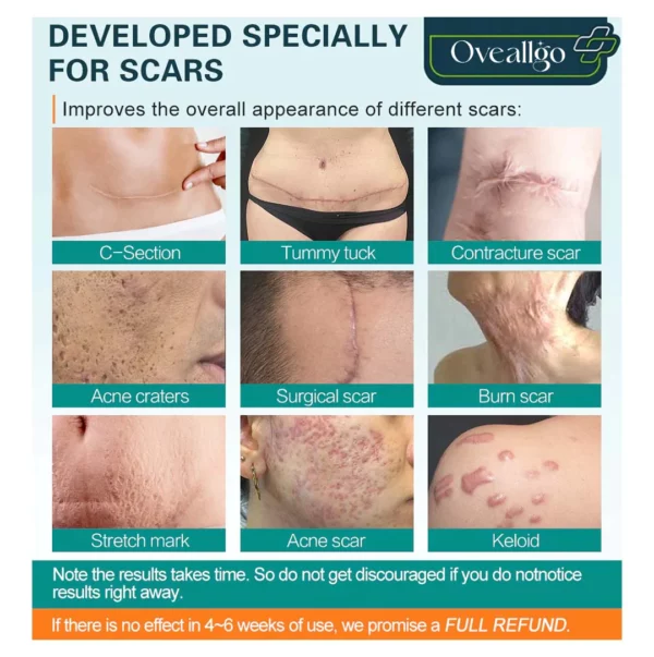 Oveallgo™ Advanced Scar Removal Spray - Image 6