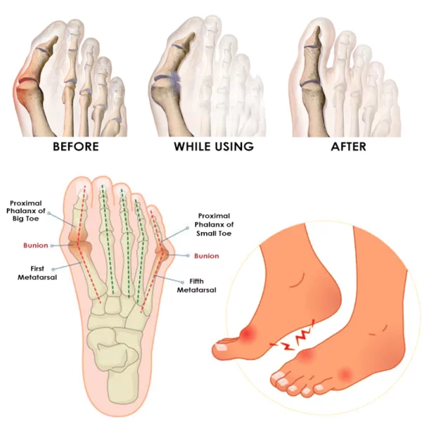 Ricpind AntiBunion VaricoseVein TourmalineSock - Image 4