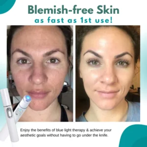 SkinMedica™ BlueLight Skin Spot Remover