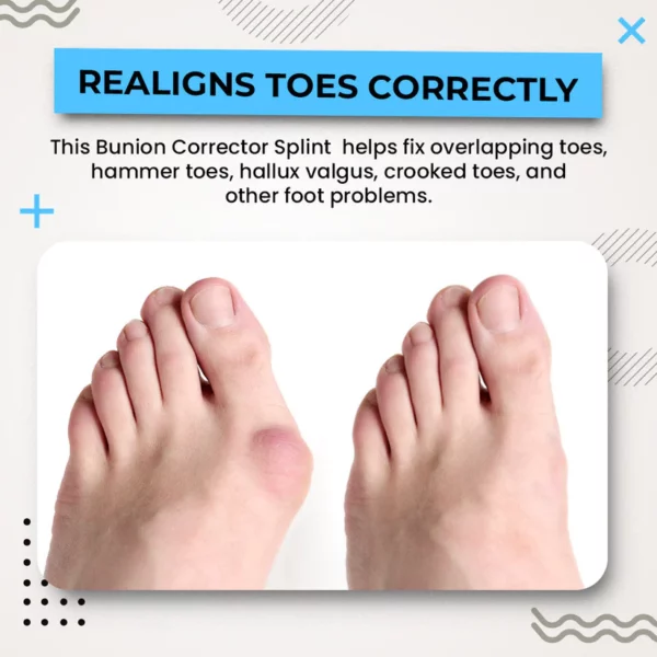 Suupillid™ 3D Instant Bunion Splint - Image 6