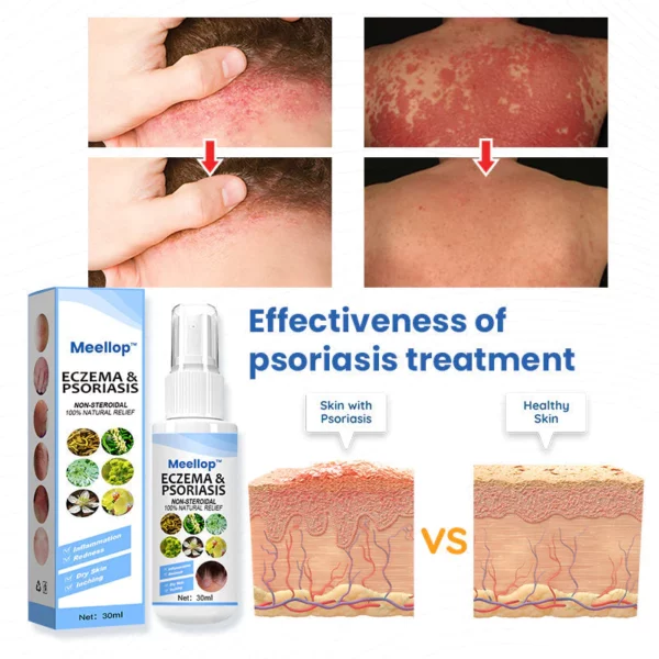 Suupillid™ Herbal Psoriasis Relief Spray - Image 6