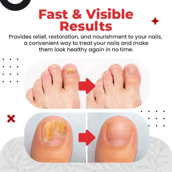 Toenail Pro™ Anti-Fungus Relief Oil - Image 3