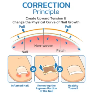 ToenailHeal Paronychia Relief Patch