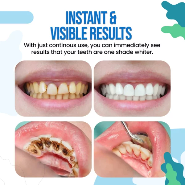 WhiteOut™ Instant Teeth Whitening Paint - Image 7