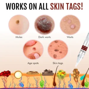 Wipe™ Tags & Moles Remover