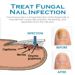 ATTDX AntiFungal NailTreatment Cream