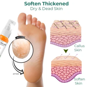 CC™ Foot Callus Removal Spray