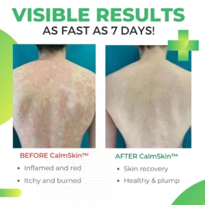 CalmSkin™ Psoriasis Defense Body Wash