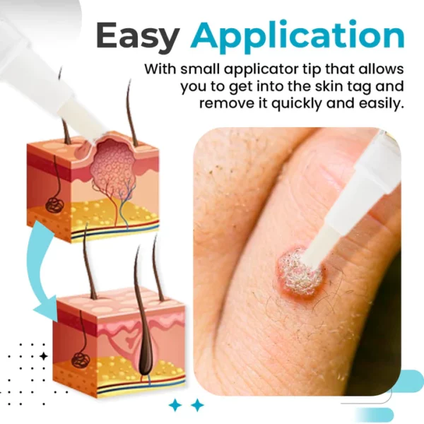 ClearTagElixir™ Skin Tag & Wart Remover Pen - Image 4