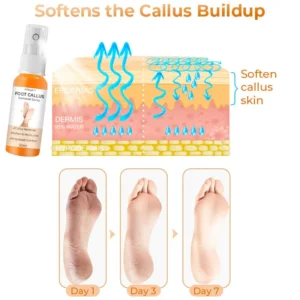 Croaie™ Anti Foot Callus Removal Spray