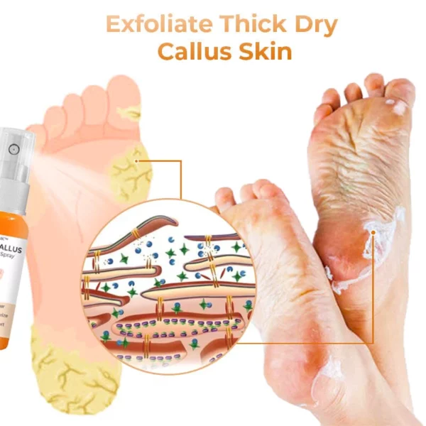 Croaie™ Anti Foot Callus Removal Spray