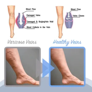 Oveallgo™ Varicose Veins Spray