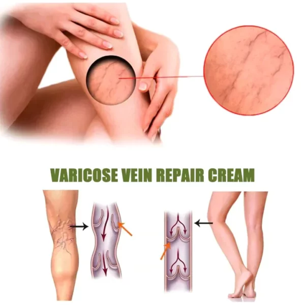 Oveallgo™ Varicose Veins Spray - Image 6