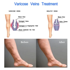 PureGlow™ Varicose Veins Treatment Spray