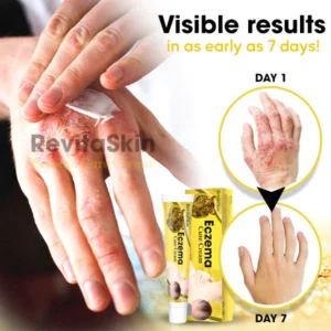 RevitaSkin™ Eczema Cure Cream