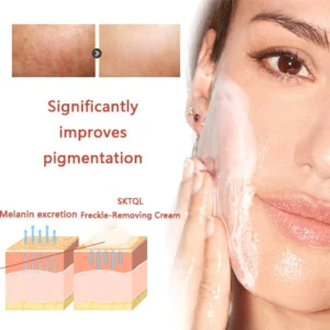 SKTQL™ Freckle-Removing Cream