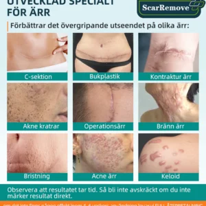 ScarRemove™ Avancerad Ärrspray