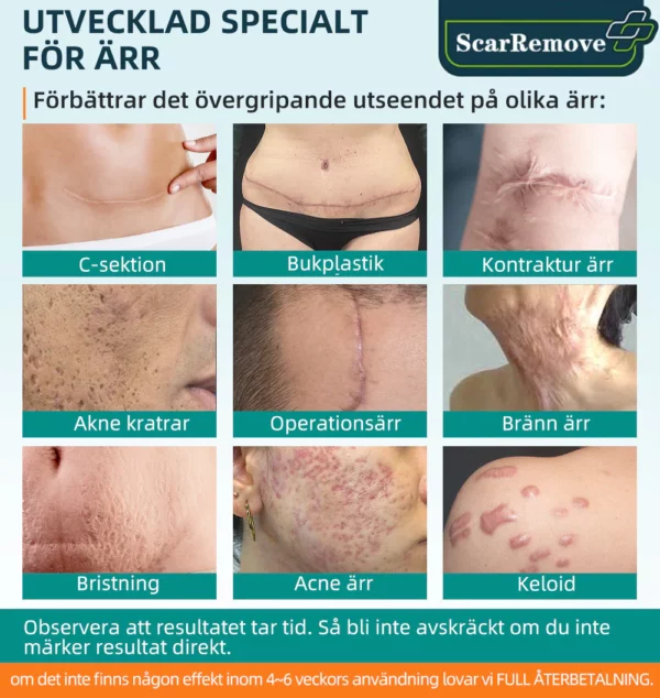 ScarRemove™ Avancerad Ärrspray