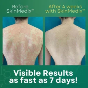 SkinMedix™ Psoriasis Cream