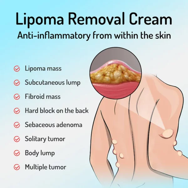 South Moon LumpFree Lipoma Removal Cream - Image 6