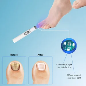 ARRIVALS Antifungal Laser Device Without Any Side Effects