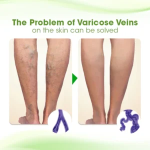 Biancat™ VariMend Varicose Vein Cream