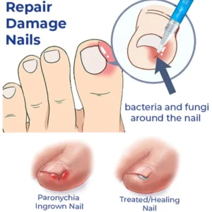 CC™ Removal Paronychia Gel