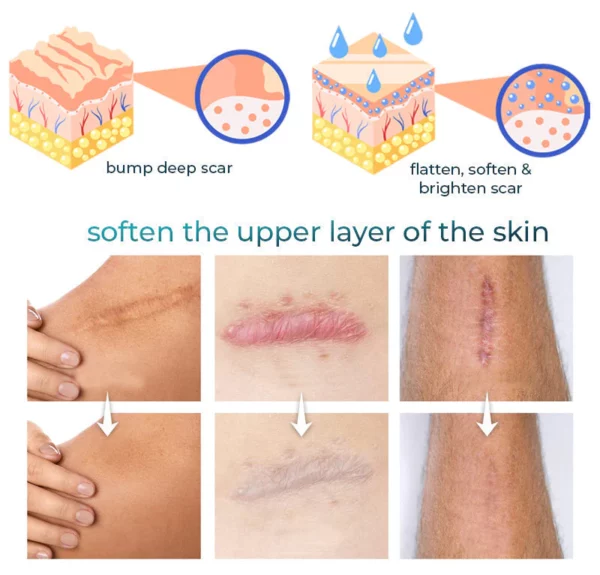 CNDB Bioskin™ Advanced Scar Removal Gel