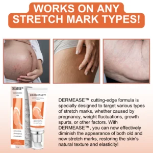 DERMEASE™ Stretchmarks Removal Cream