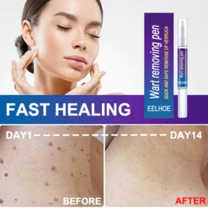 EELHOE ™ Skin Tag Remover