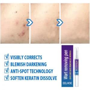 EELHOE ™ Skin Tag Remover