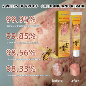 EdiJonah® Bee Venom Psoriasis Treatment Cream