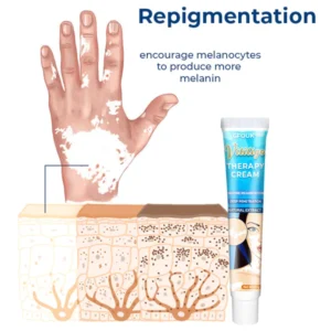 GFOUK™ Vitiligo-Therapie-Creme