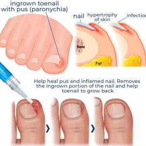 LEFUN Removal Paronychia Gel