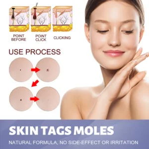 OUHOE™ Tags & Moles Remover