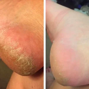 Oveallgo™ FX Foot Callus Removal Spray