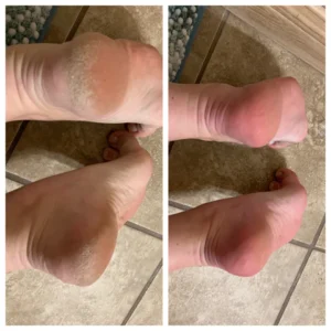 Oveallgo™ FX Foot Callus Removal Spray